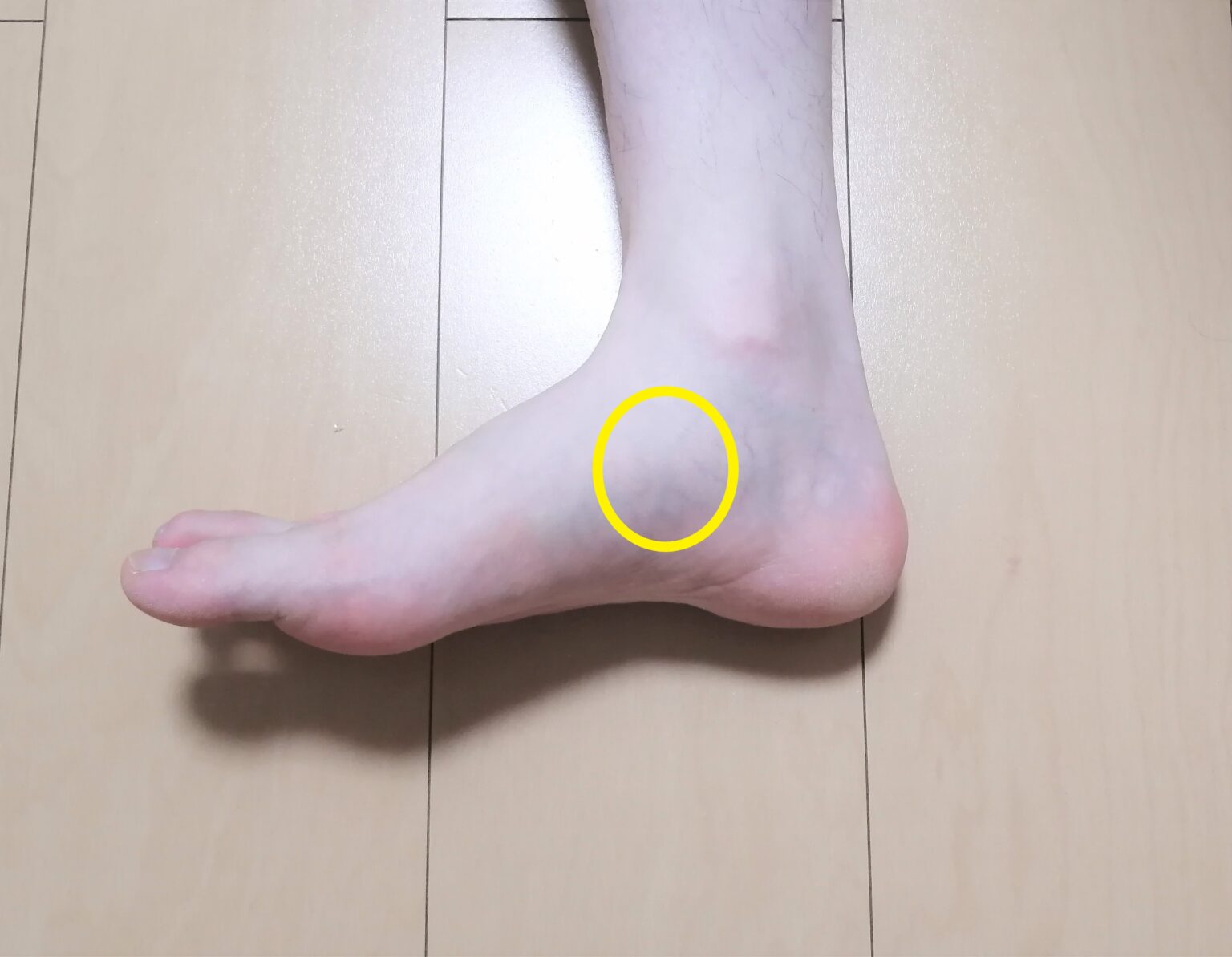 内くるぶし 骨折 _ 捻挫 骨折 見分け方 – BAOBZ